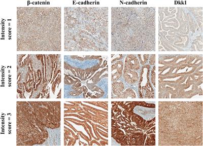 The association of Wnt-signalling and EMT markers with clinical characteristics in women with endometrial cancer